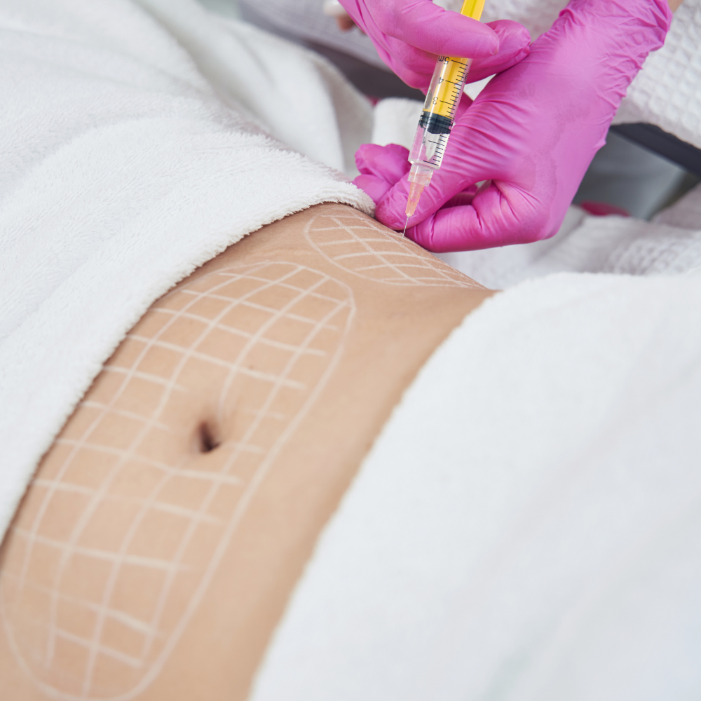 Mesoterapia corporal